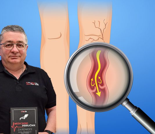 Bolesne vene i ronjenje